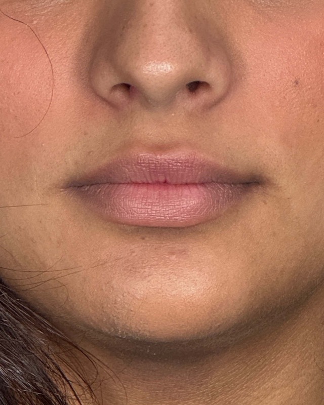Juvederm Before & After Image