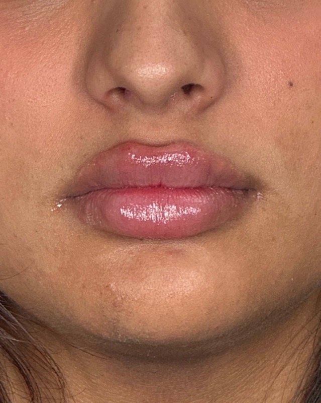 Juvederm Before & After Image