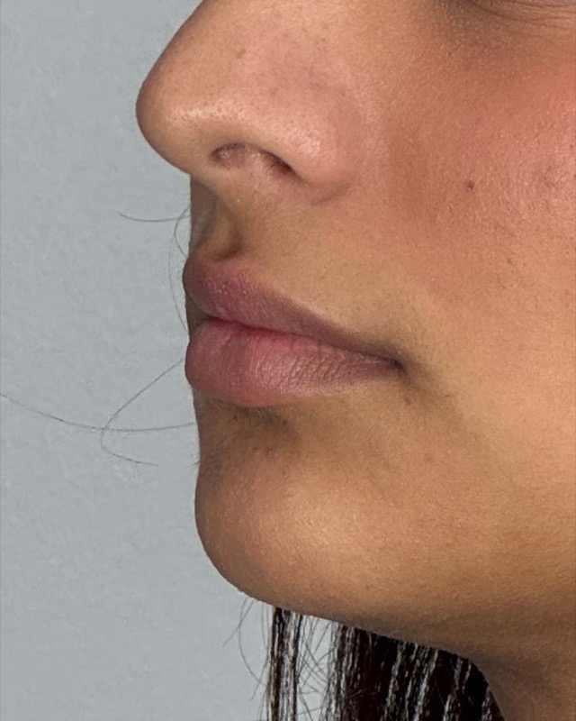 Juvederm Before & After Image