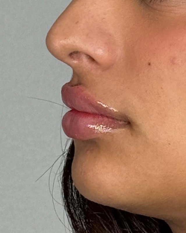 Juvederm Before & After Image