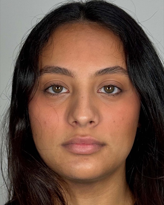 Juvederm Before & After Image
