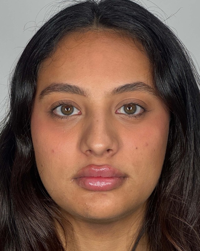 Juvederm Before & After Image