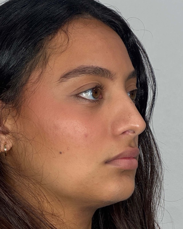 Juvederm Before & After Image