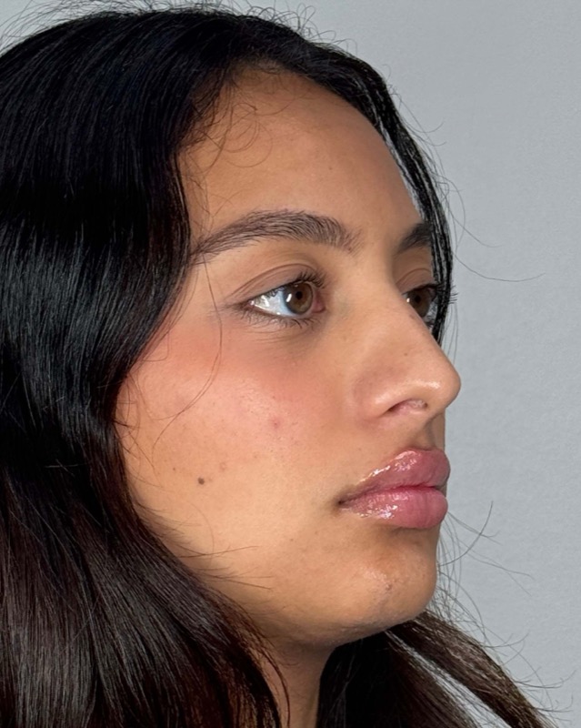 Juvederm Before & After Image