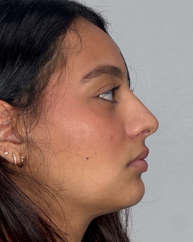 Juvederm Before & After Image