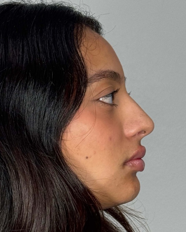 Juvederm Before & After Image