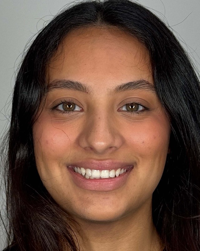 Juvederm Before & After Image