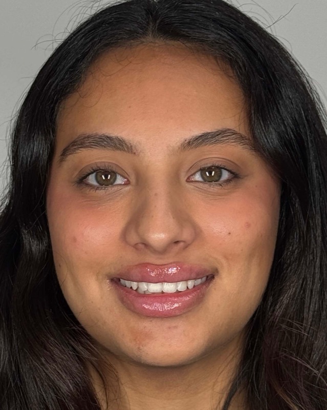 Juvederm Before & After Image