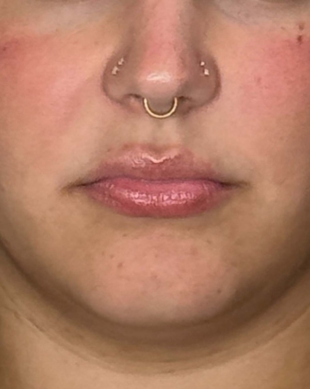 Juvederm Before & After Image