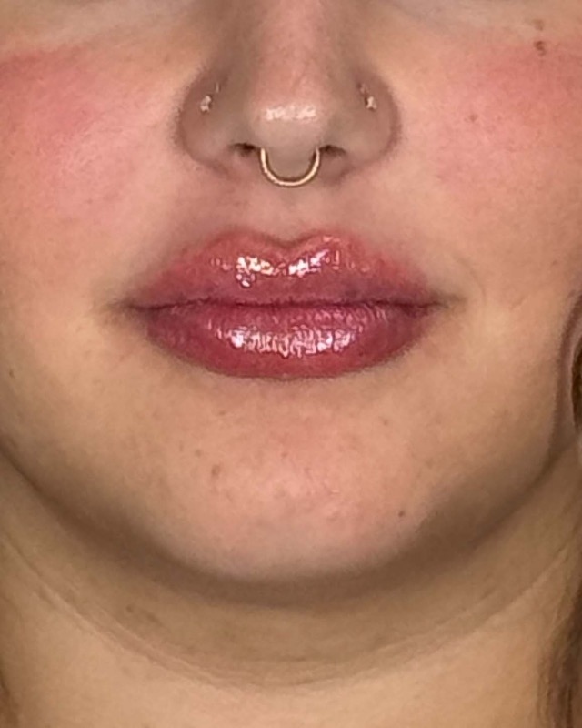 Juvederm Before & After Image
