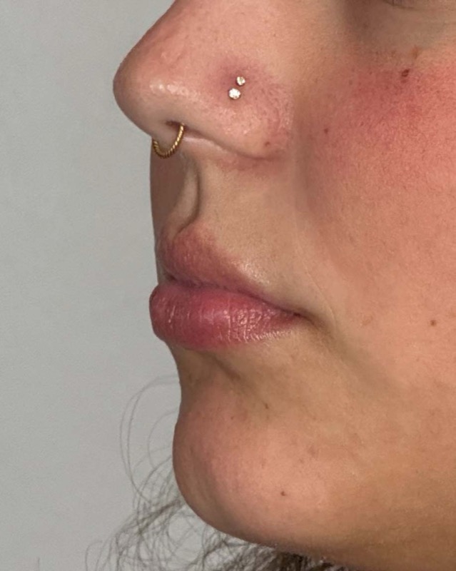 Juvederm Before & After Image