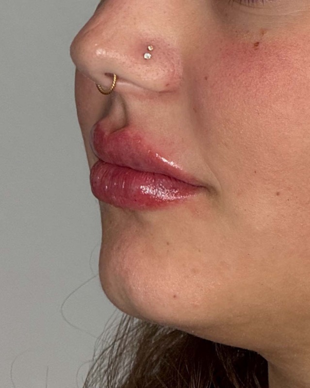 Juvederm Before & After Image
