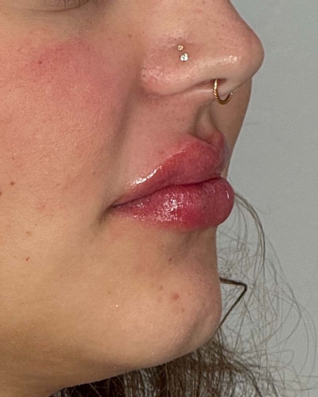 Juvederm Before & After Image