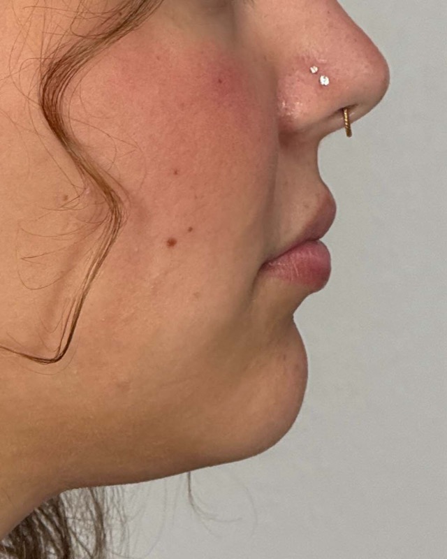 Juvederm Before & After Image