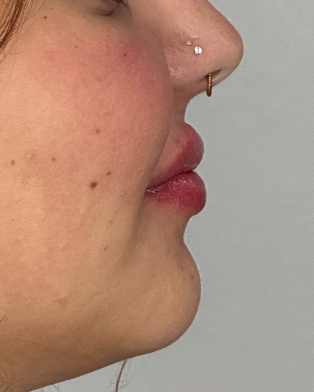 Juvederm Before & After Image