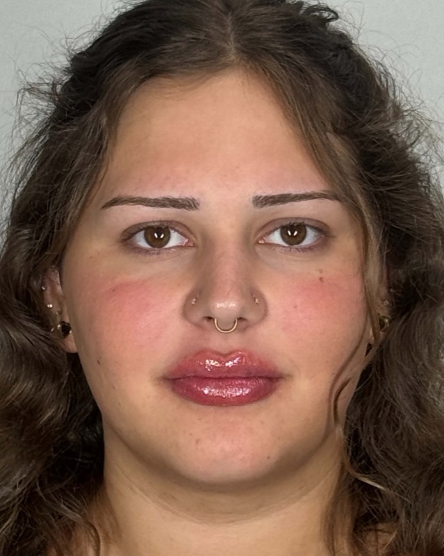 Juvederm Before & After Image