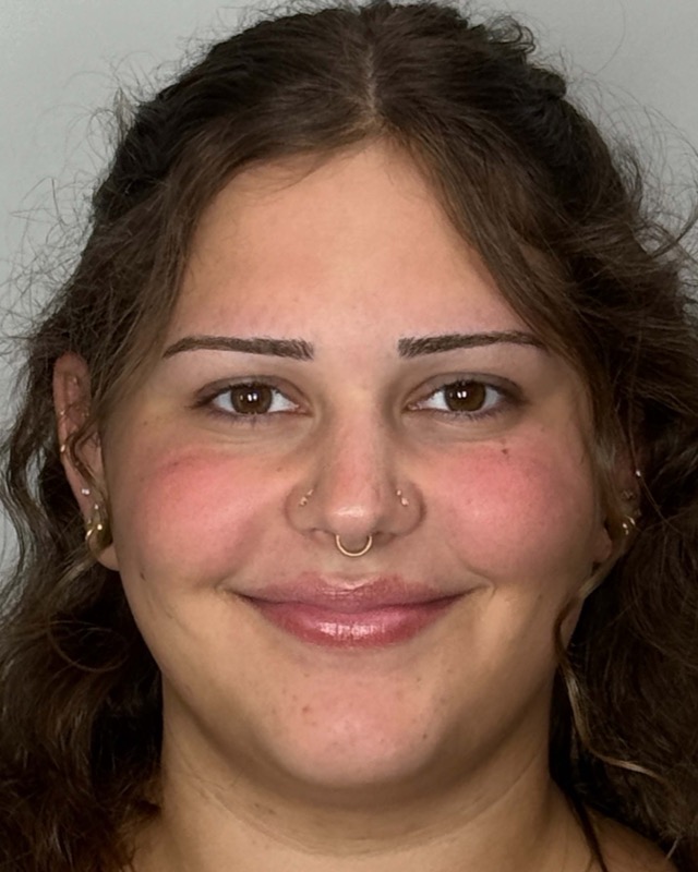 Juvederm Before & After Image