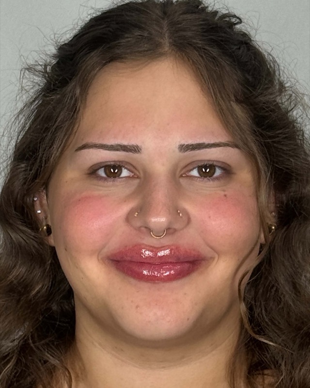 Juvederm Before & After Image