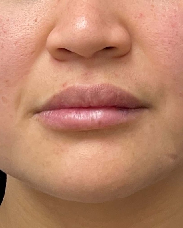 Juvederm Before & After Image