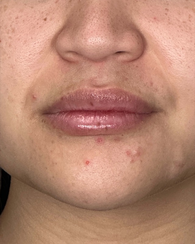 Juvederm Before & After Image