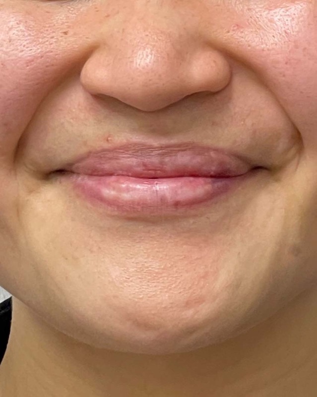 Juvederm Before & After Image
