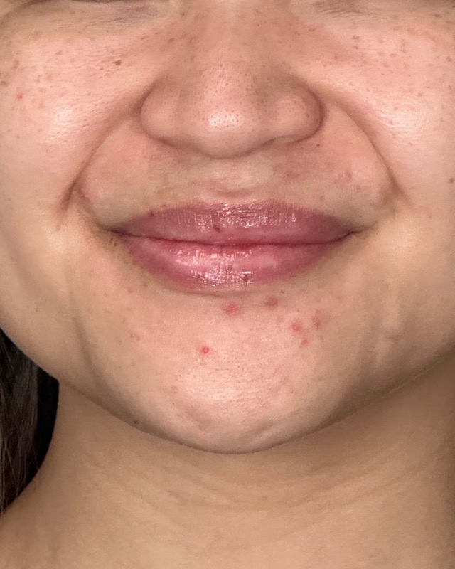 Juvederm Before & After Image