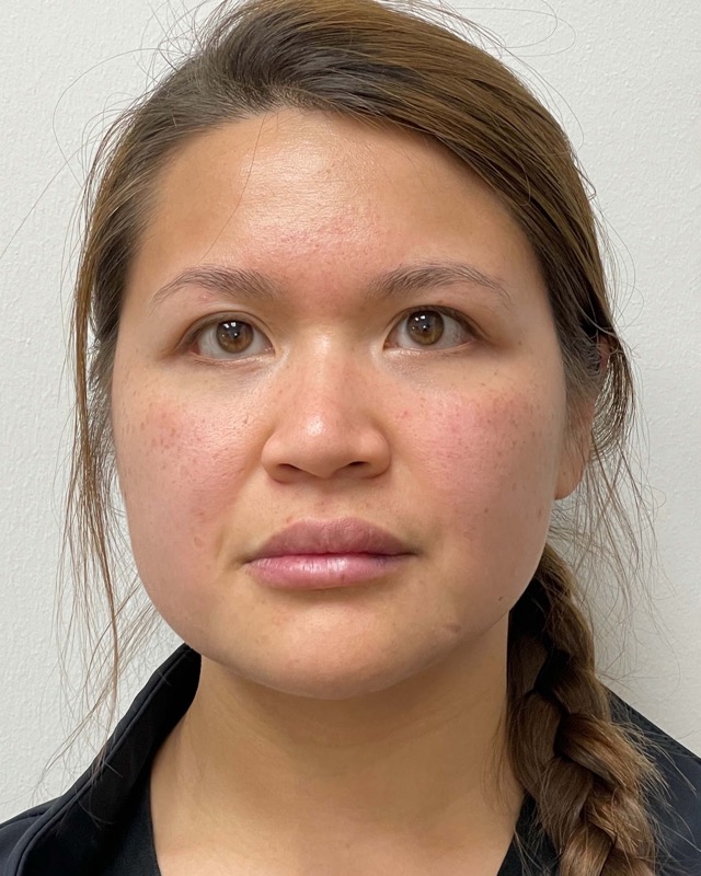 Juvederm Before & After Image