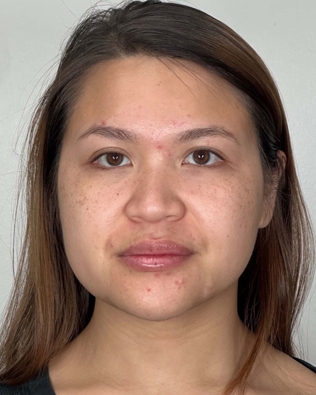 Juvederm Before & After Image