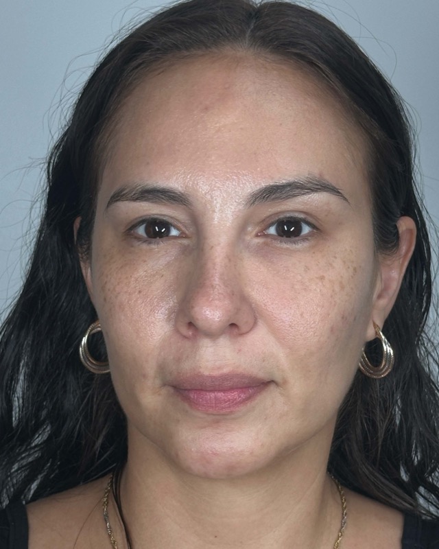 Juvederm Before & After Image