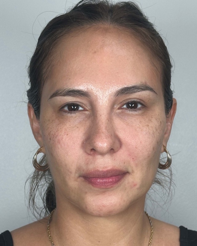 Juvederm Before & After Image