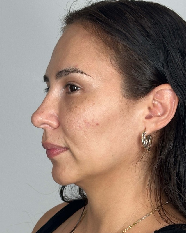 Juvederm Before & After Image