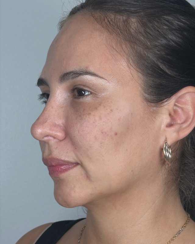 Juvederm Before & After Image