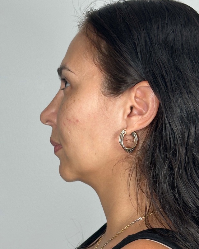 Juvederm Before & After Image