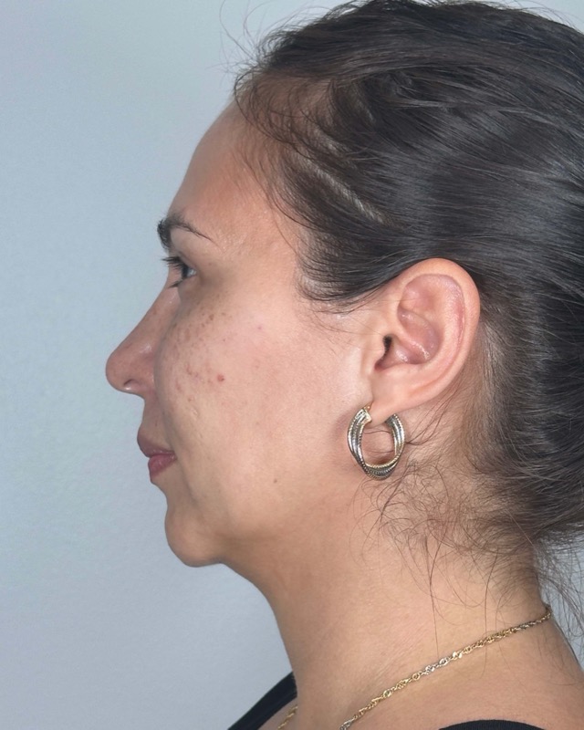 Juvederm Before & After Image