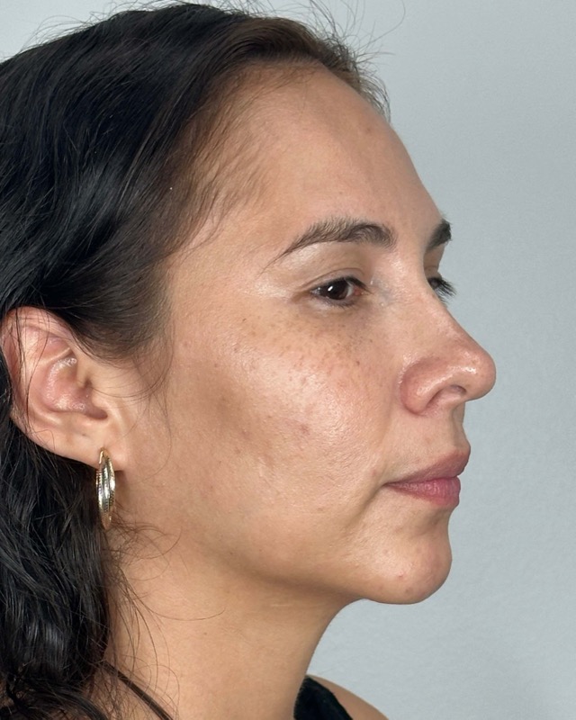 Juvederm Before & After Image