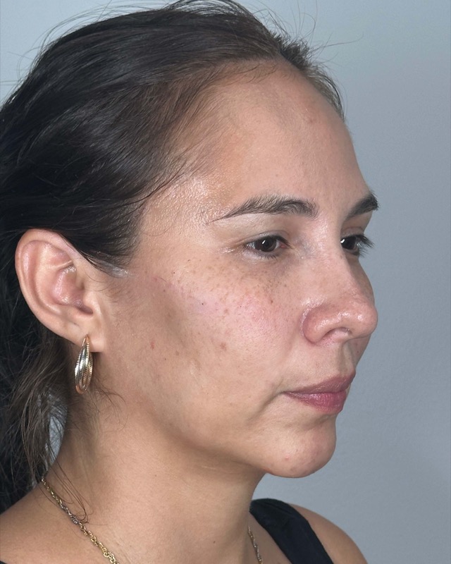 Juvederm Before & After Image