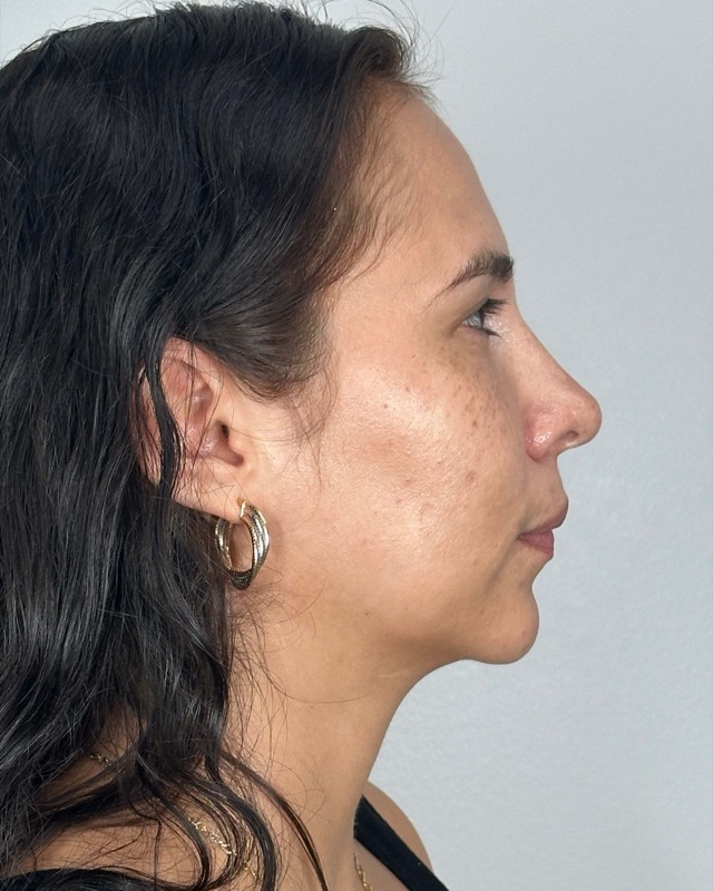 Juvederm Before & After Image