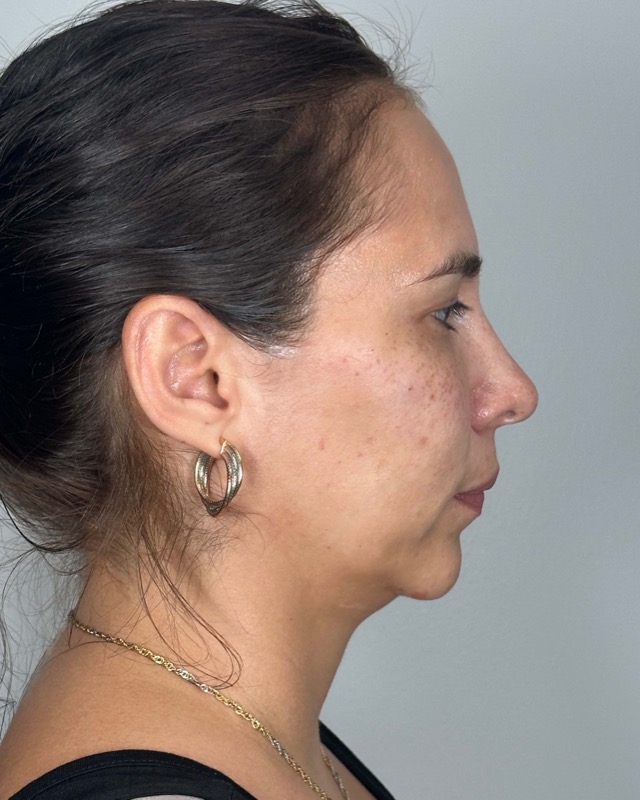 Juvederm Before & After Image