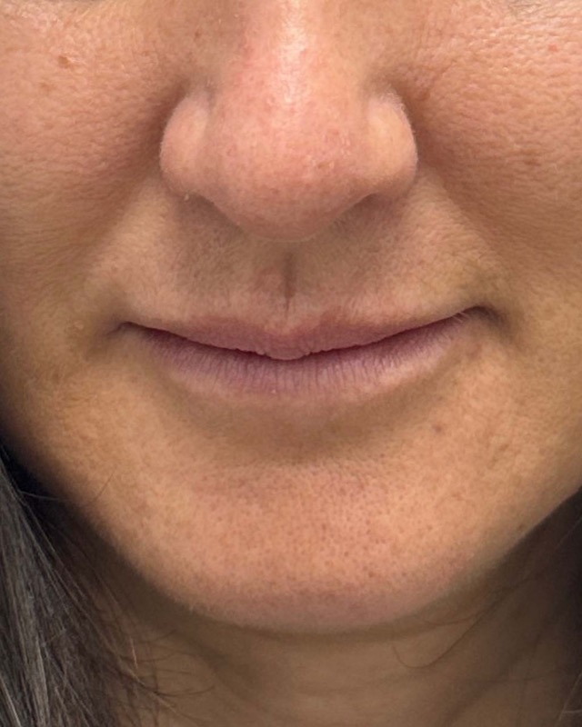 Juvederm Before & After Image