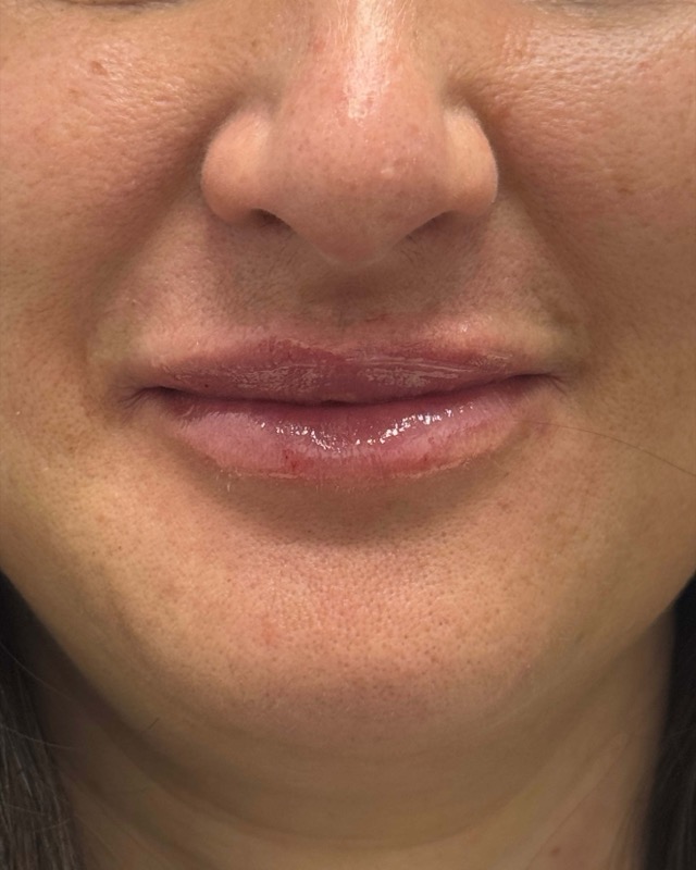 Juvederm Before & After Image