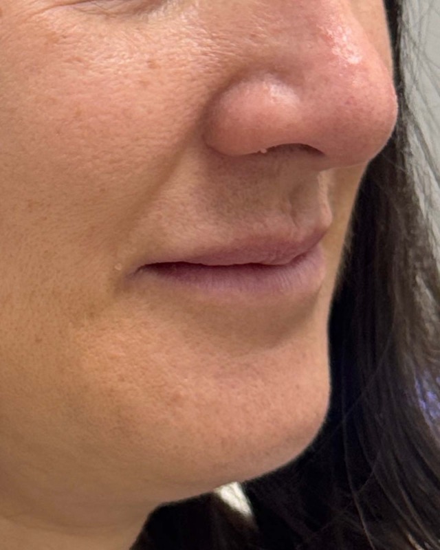 Juvederm Before & After Image