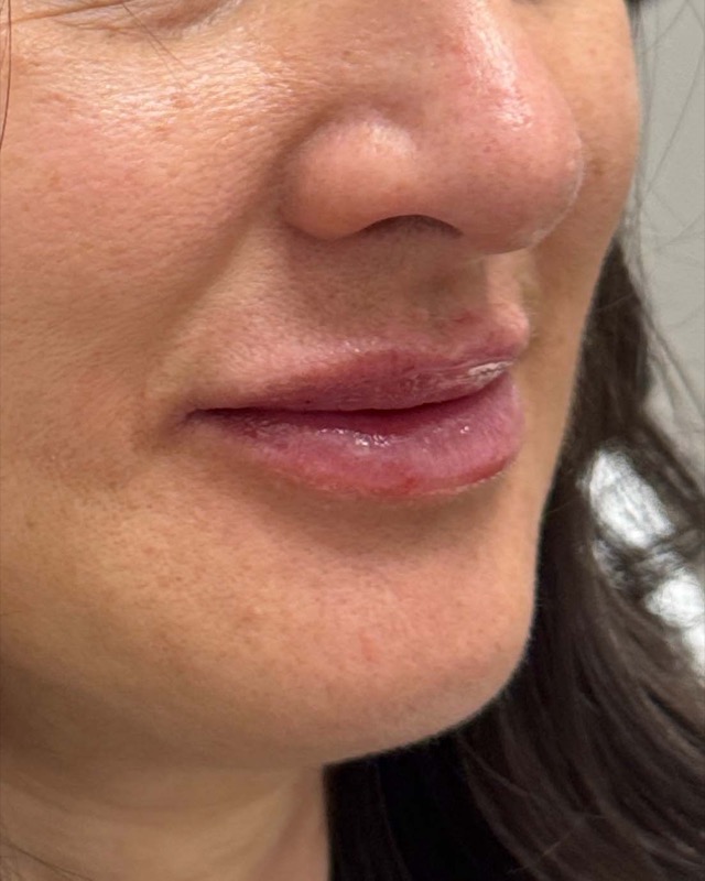 Juvederm Before & After Image