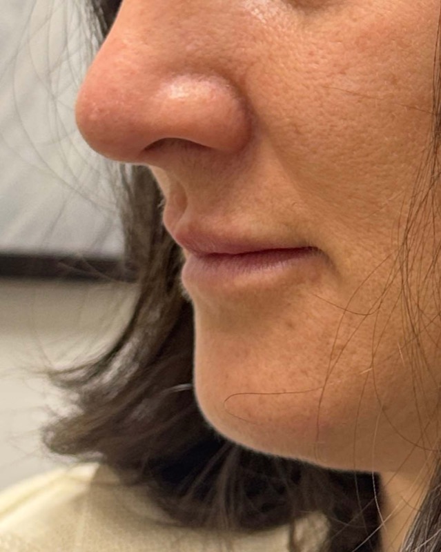 Juvederm Before & After Image