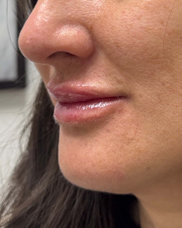 Juvederm Before & After Image