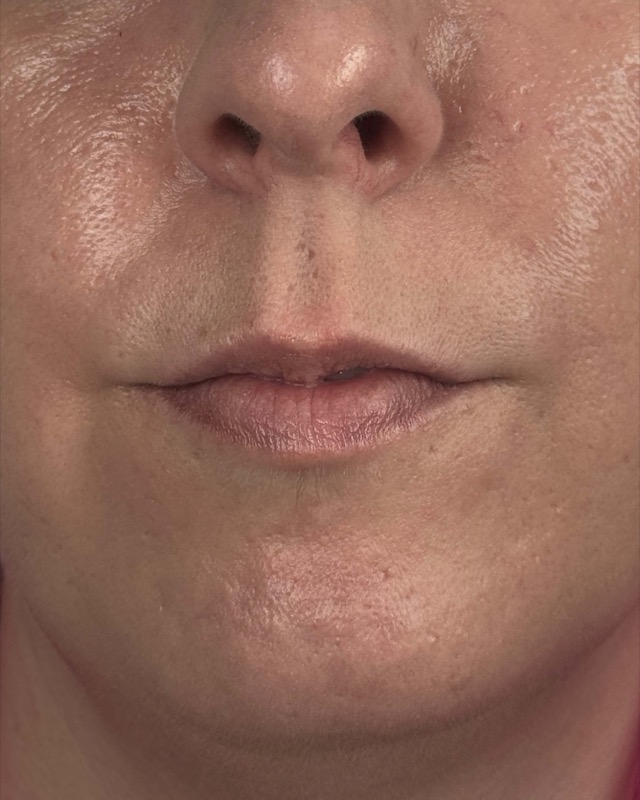 Juvederm Before & After Image