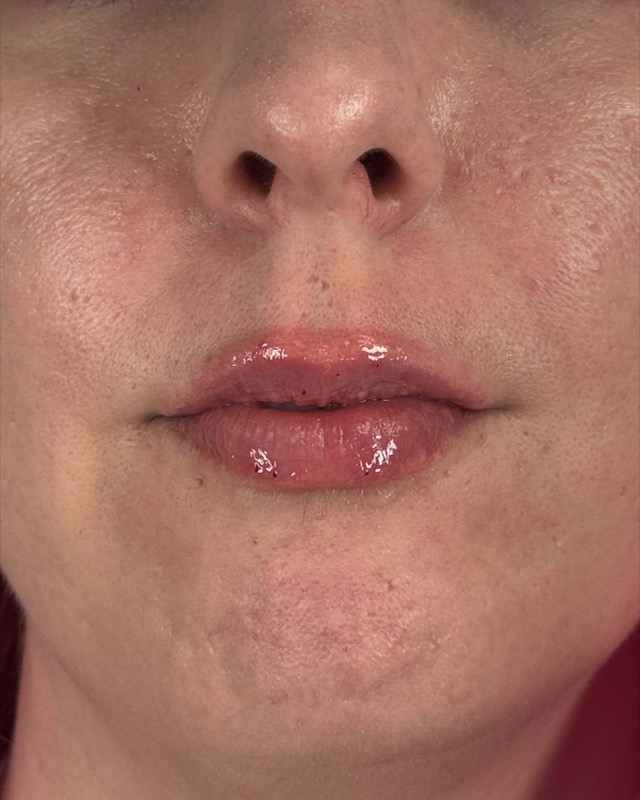 Juvederm Before & After Image