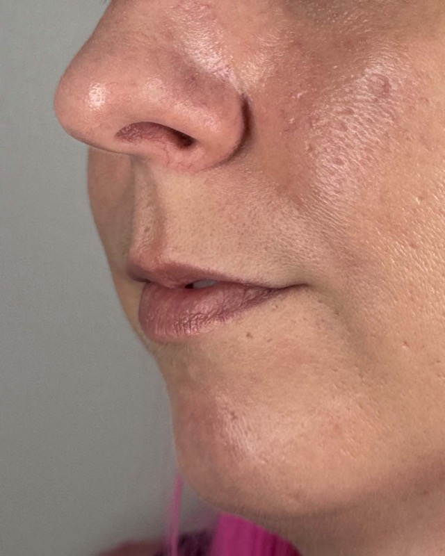 Juvederm Before & After Image