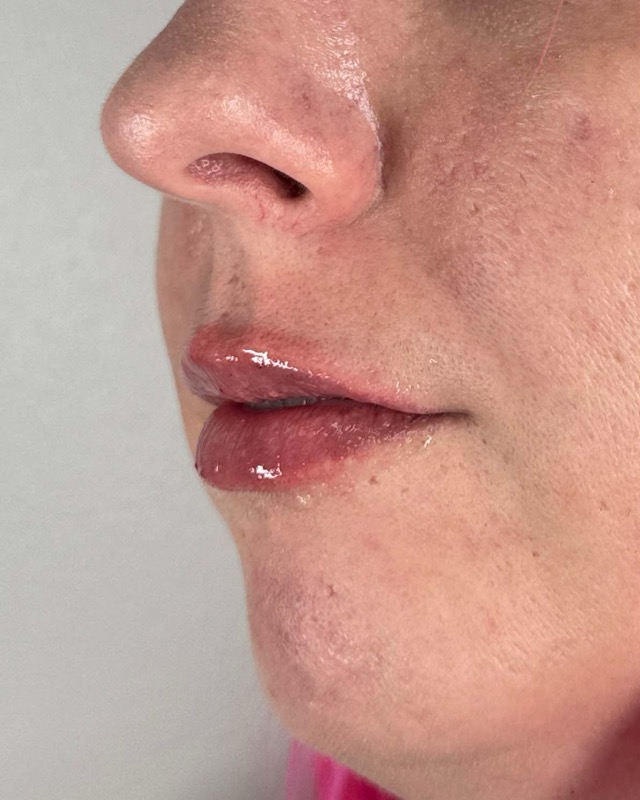 Juvederm Before & After Image