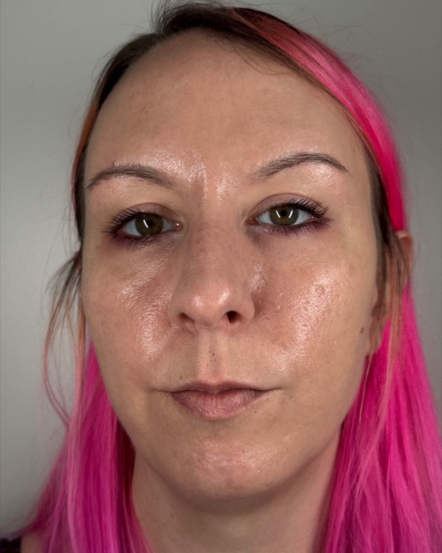 Juvederm Before & After Image