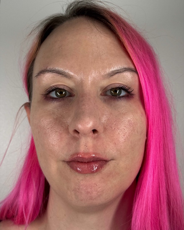 Juvederm Before & After Image